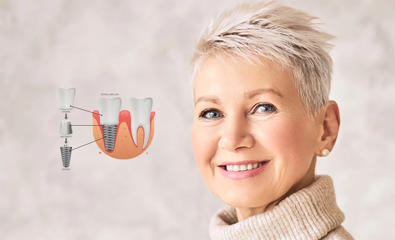 Dental Implants