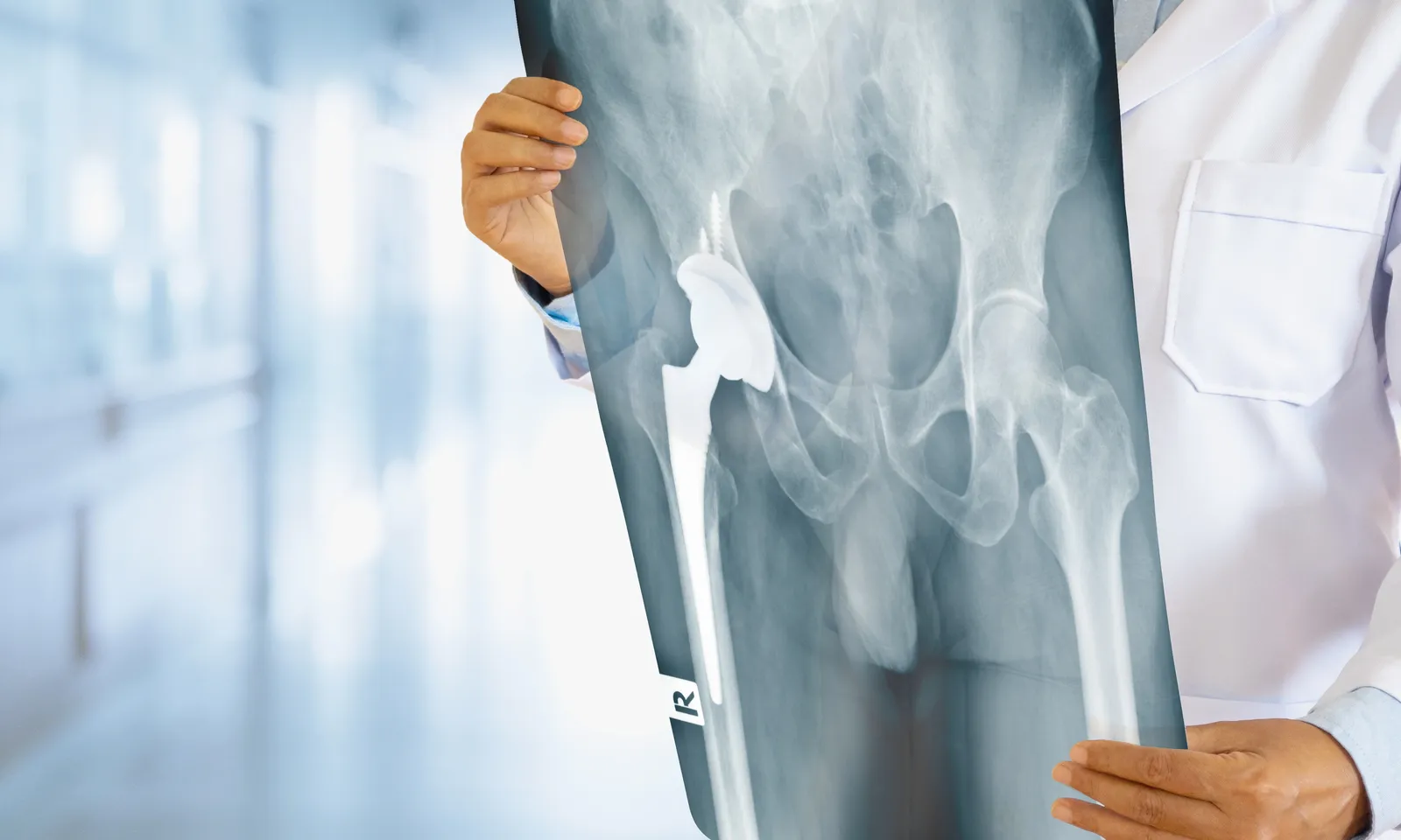 Surgeon holding an X-ray showing a hip replacement implant in place