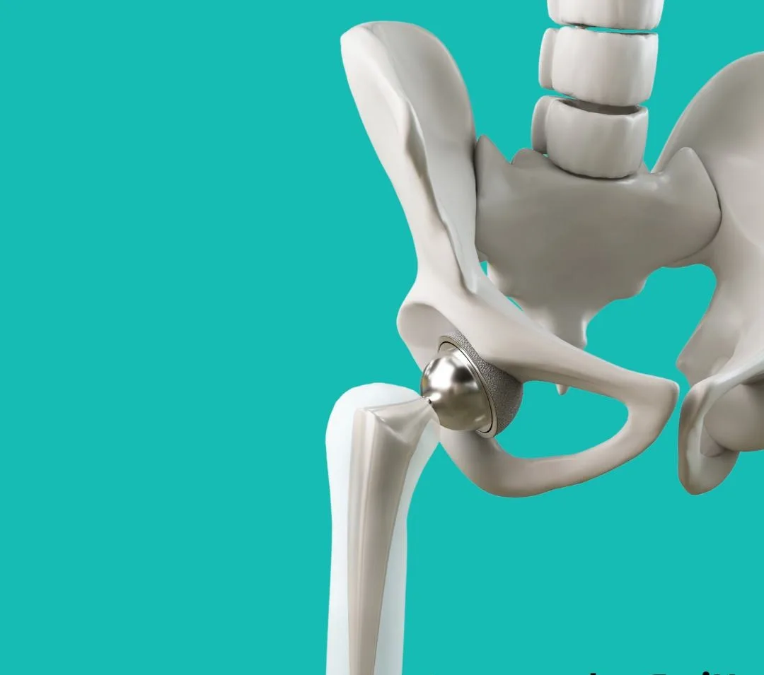 Total Hip Replacement